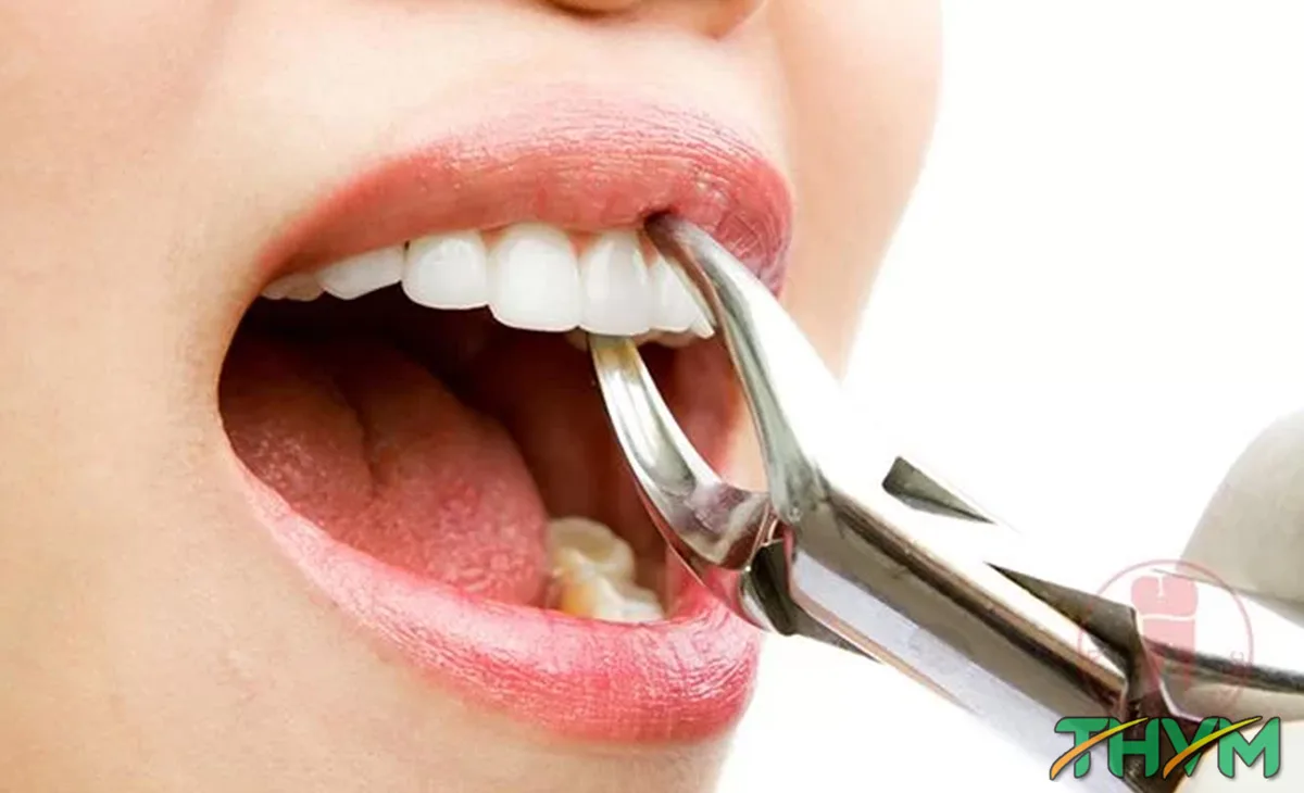 có nên nhổ răng giá rẻ